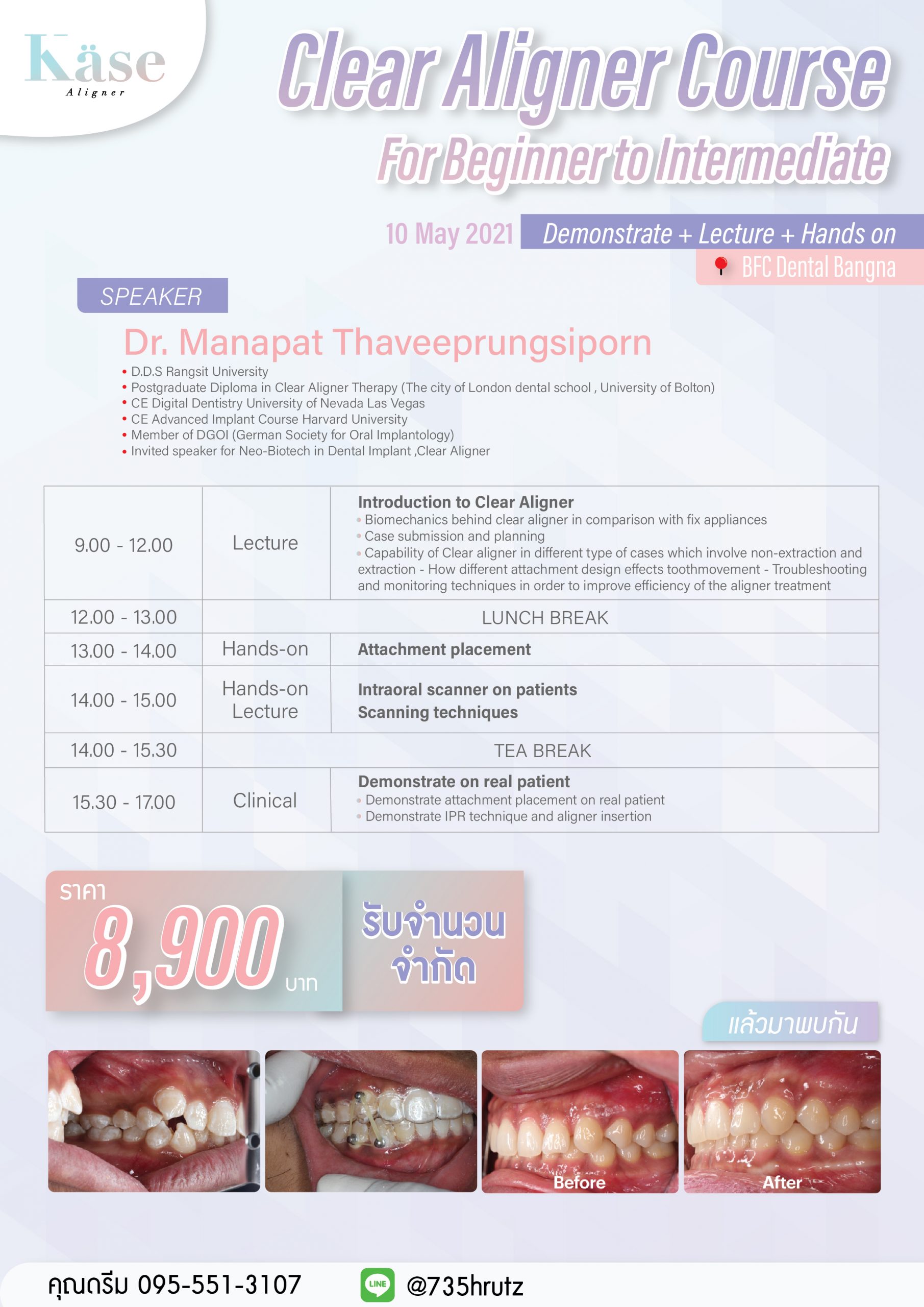 Clear Aligner For Beginner to Intermidiate IMMO